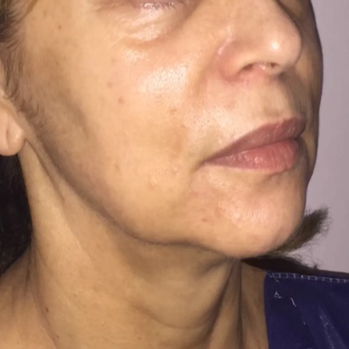 Rosto de perfil antes do facelifting, com flacidez no pescoço