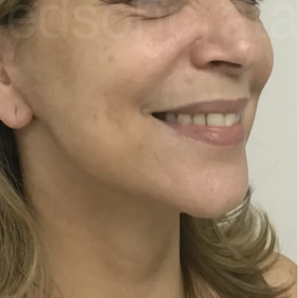 Rosto de perfil depois do facelifting, com pescoço e mandíbula mais firmes