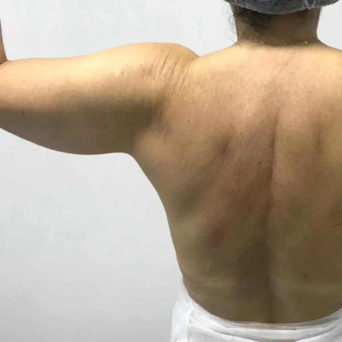 Braço e costas antes da hidrolipo, com acúmulo de gordura localizada e flacidez