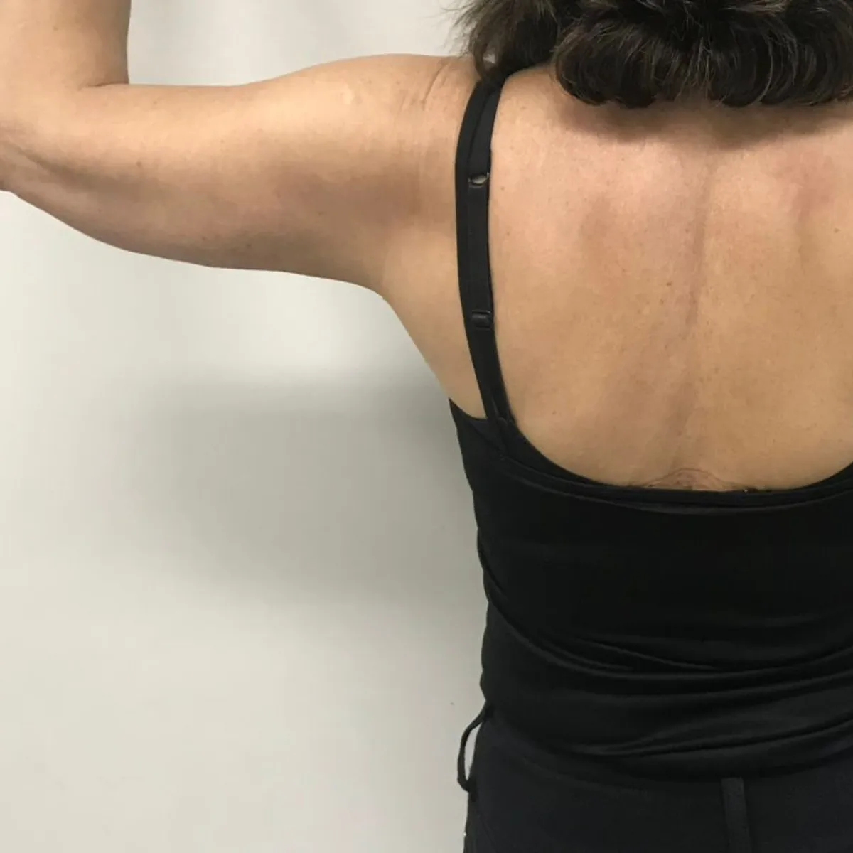 Braço e costas depois da hidrolipo, com contorno mais definido