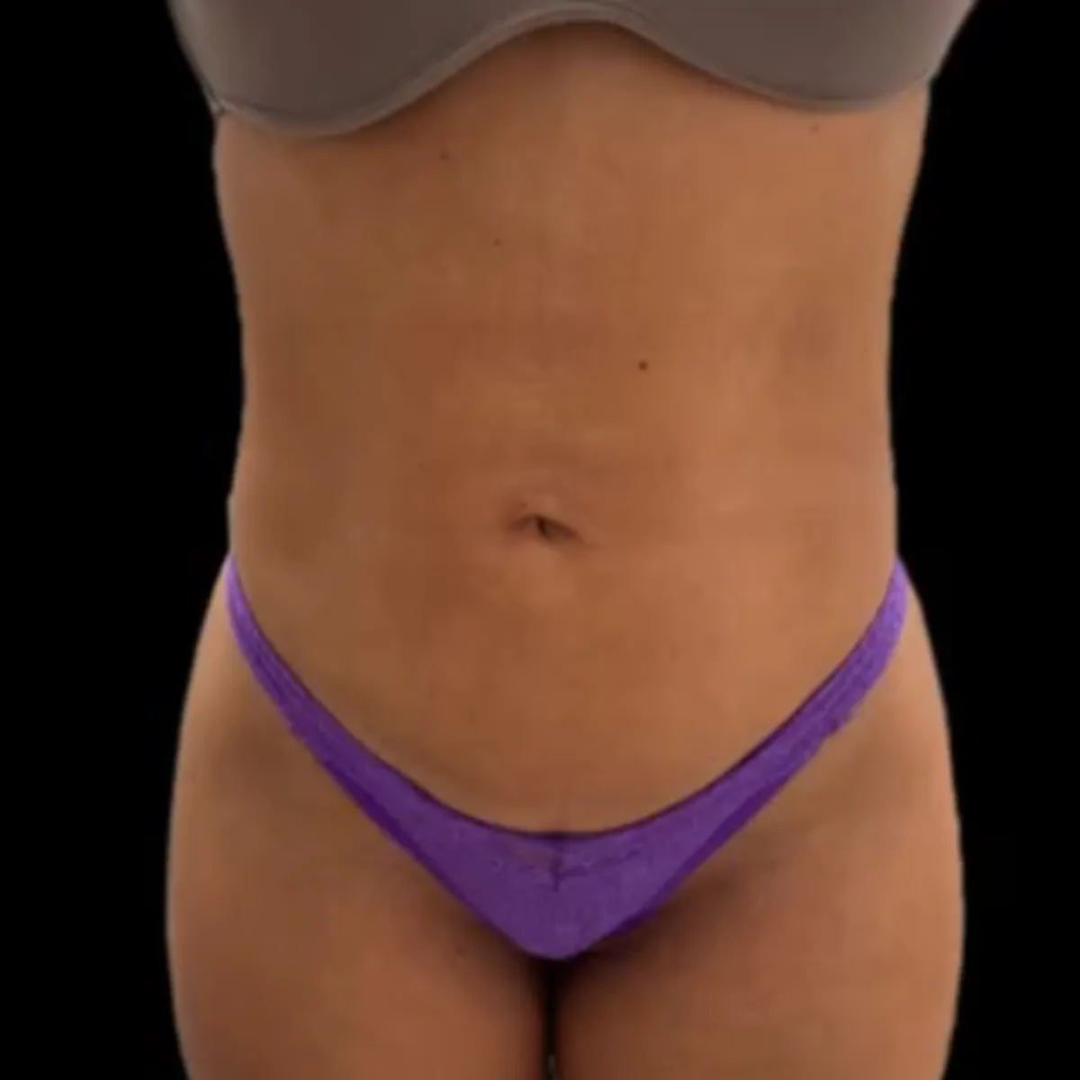 Abdômen e quadril depois da lipo a laser, com contorno mais definido