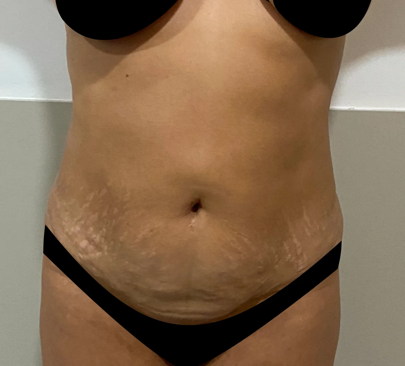 Abdômen antes da lipoabdominoplastia, com flacidez e estrias