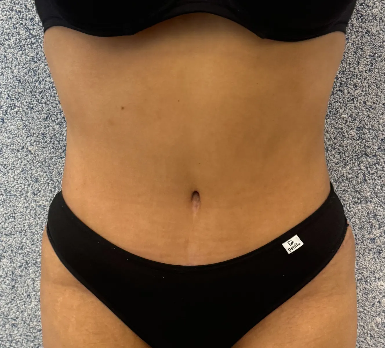 Abdômen depois da lipoabdominoplastia, plano e definido