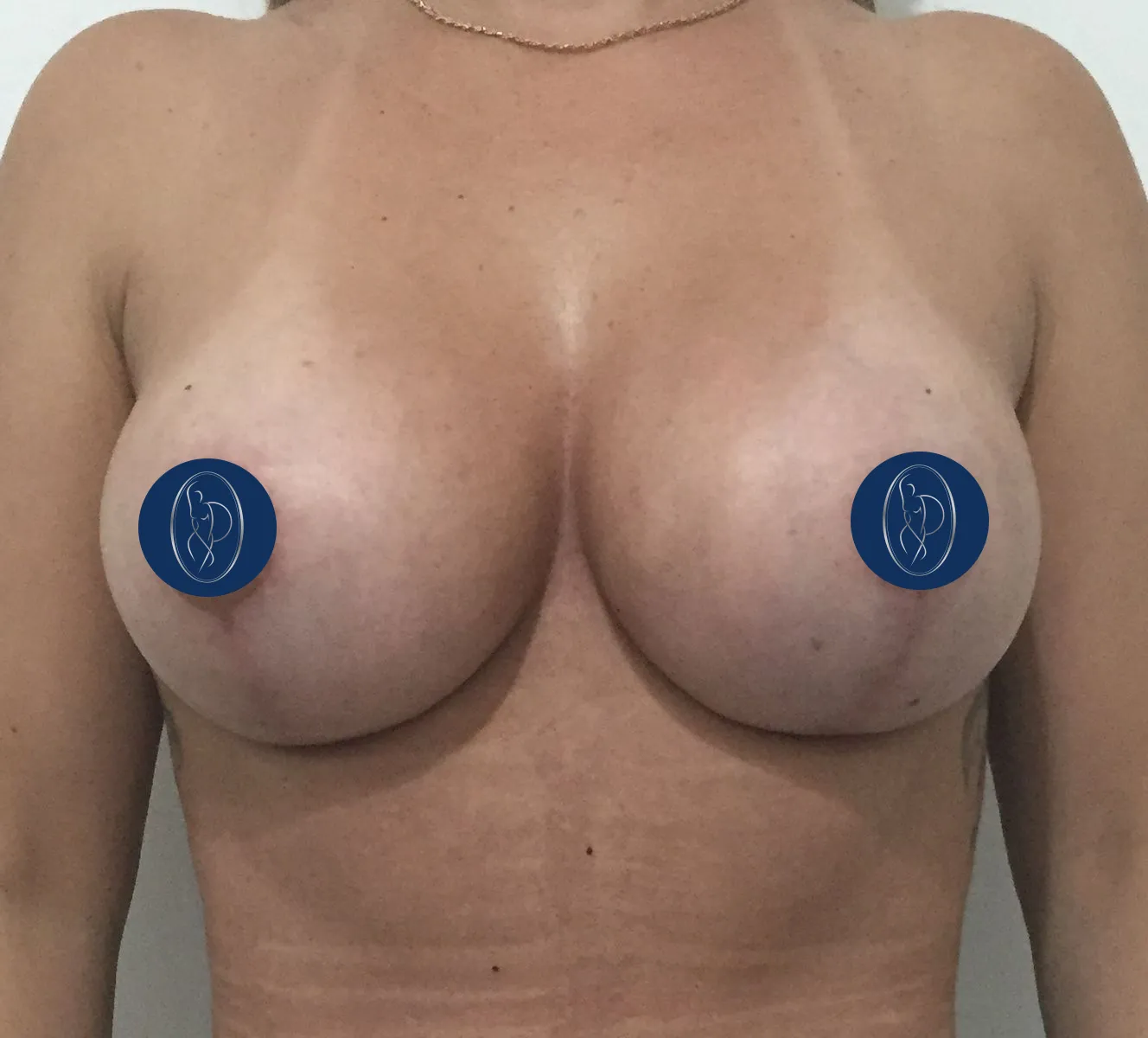 Mamas depois da mastopexia, elevadas e com volume proporcional