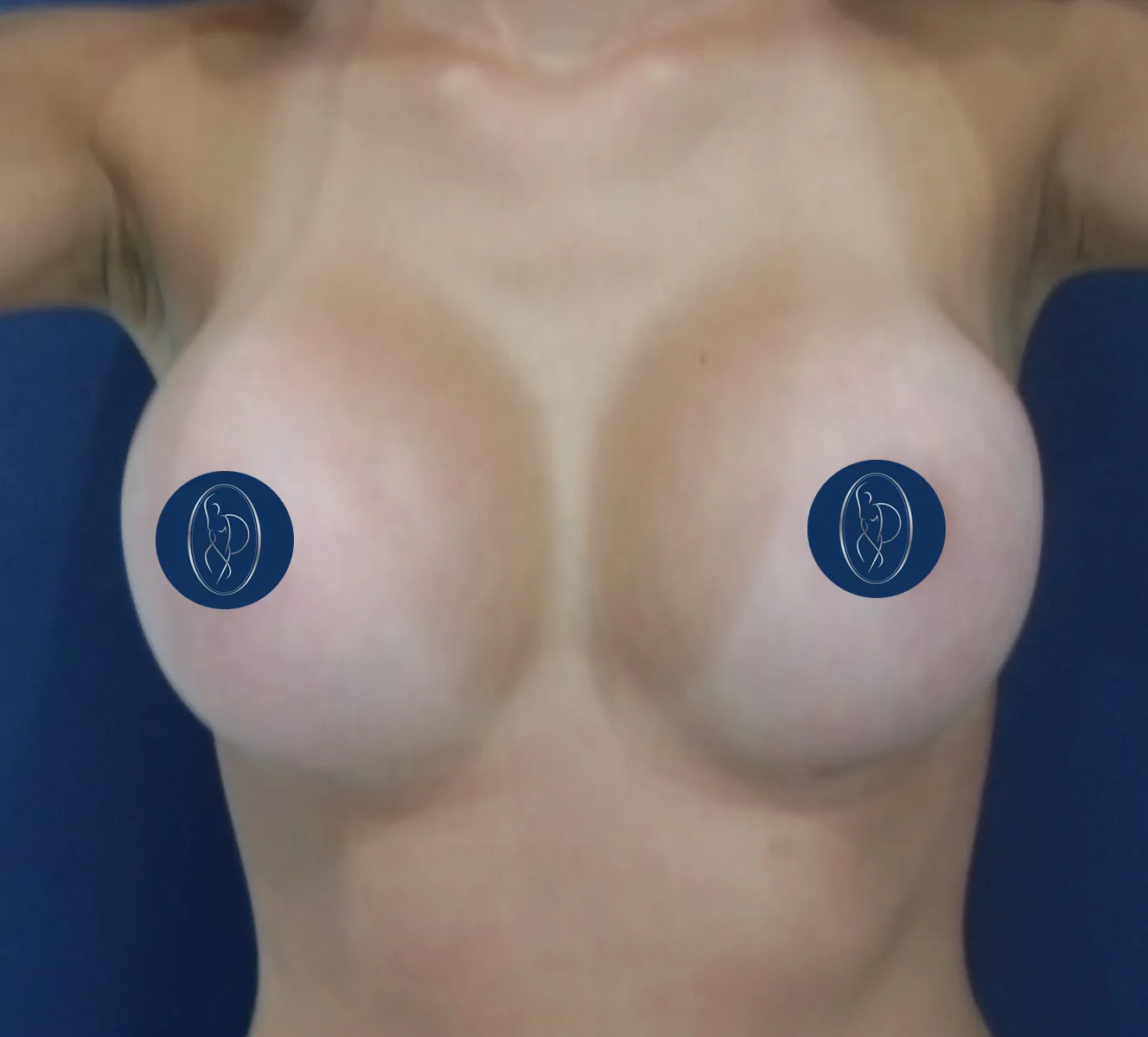 Mamas depois da prótese de recuperação rápida, com volume e forma naturais